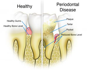 lanap surgery hingham and norwood