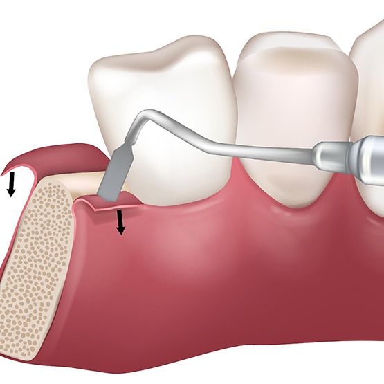 Illustration of gum tissue being folded back during periodontal regeneration procedure