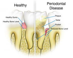 Gum Disease Treatment.