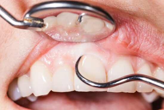 Healthy gums and teeth receiving a cleaning.