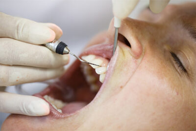 Periodontal probe for measuring pocket depths.