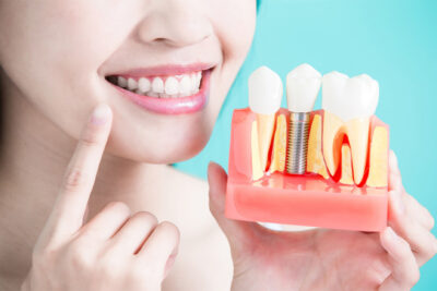 Woman smiling while displaying tooth implant modal.