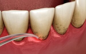 Illustration of dental laser being used along the gumline