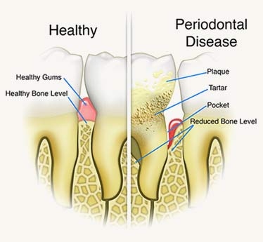 signs of periodontal disease